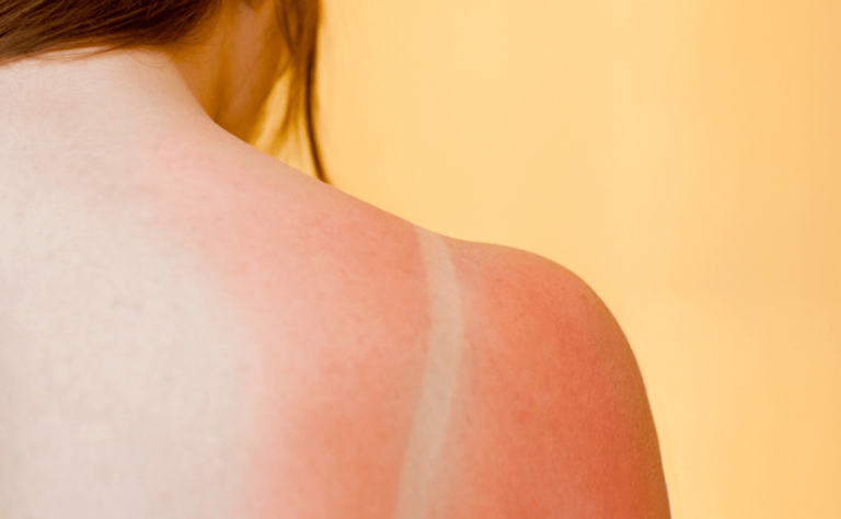 a woman with a sunburn on her shoulder