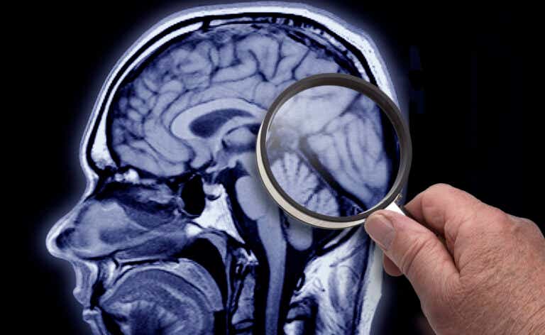 MRI image of brain