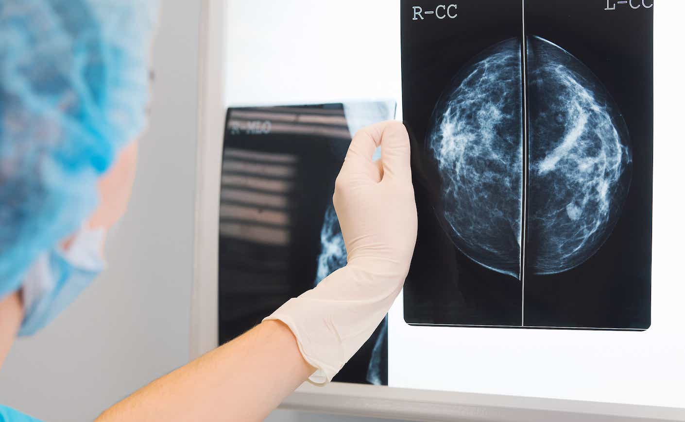 doctor holding up a breast xray