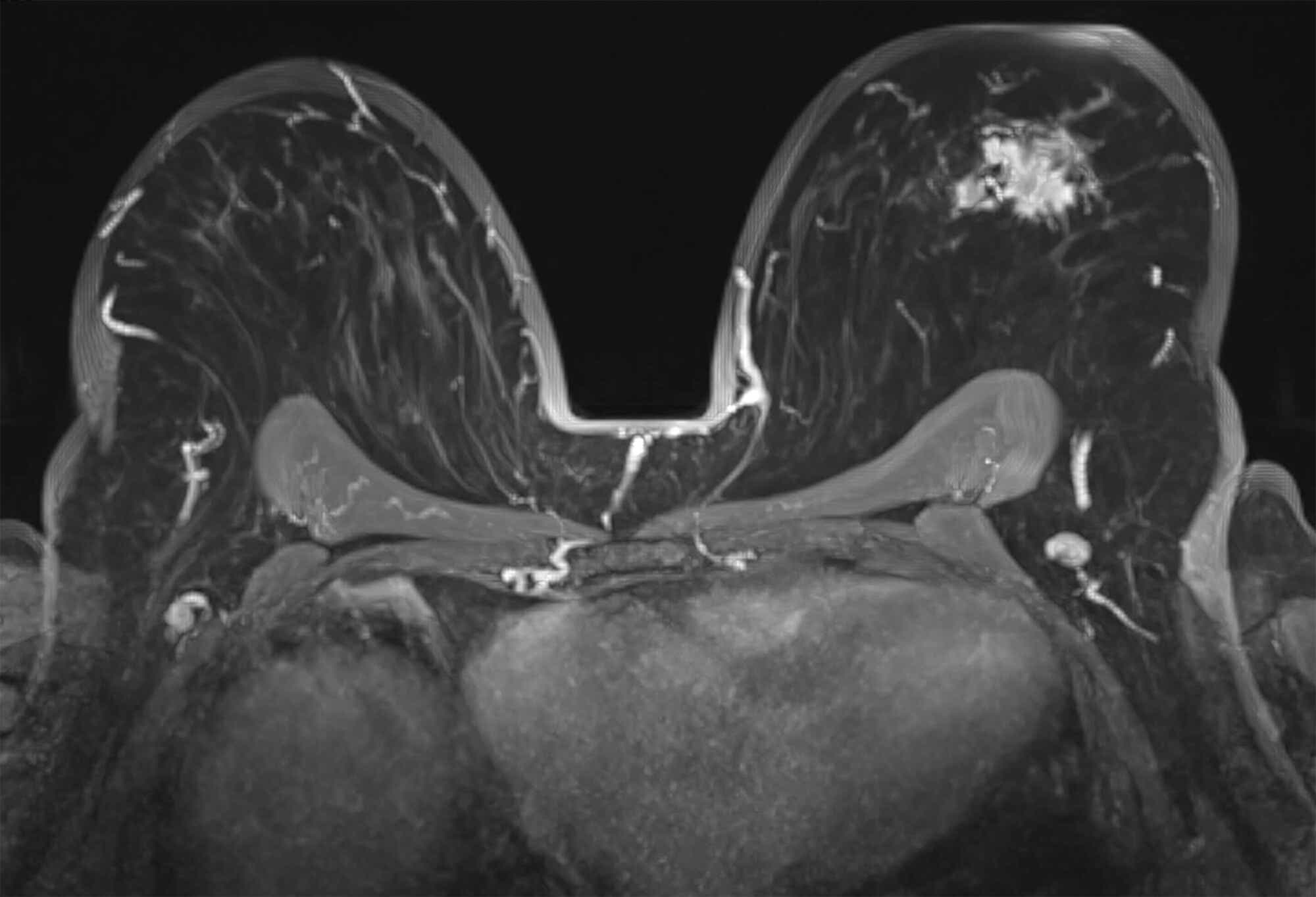 Imaging in Breast Cancer