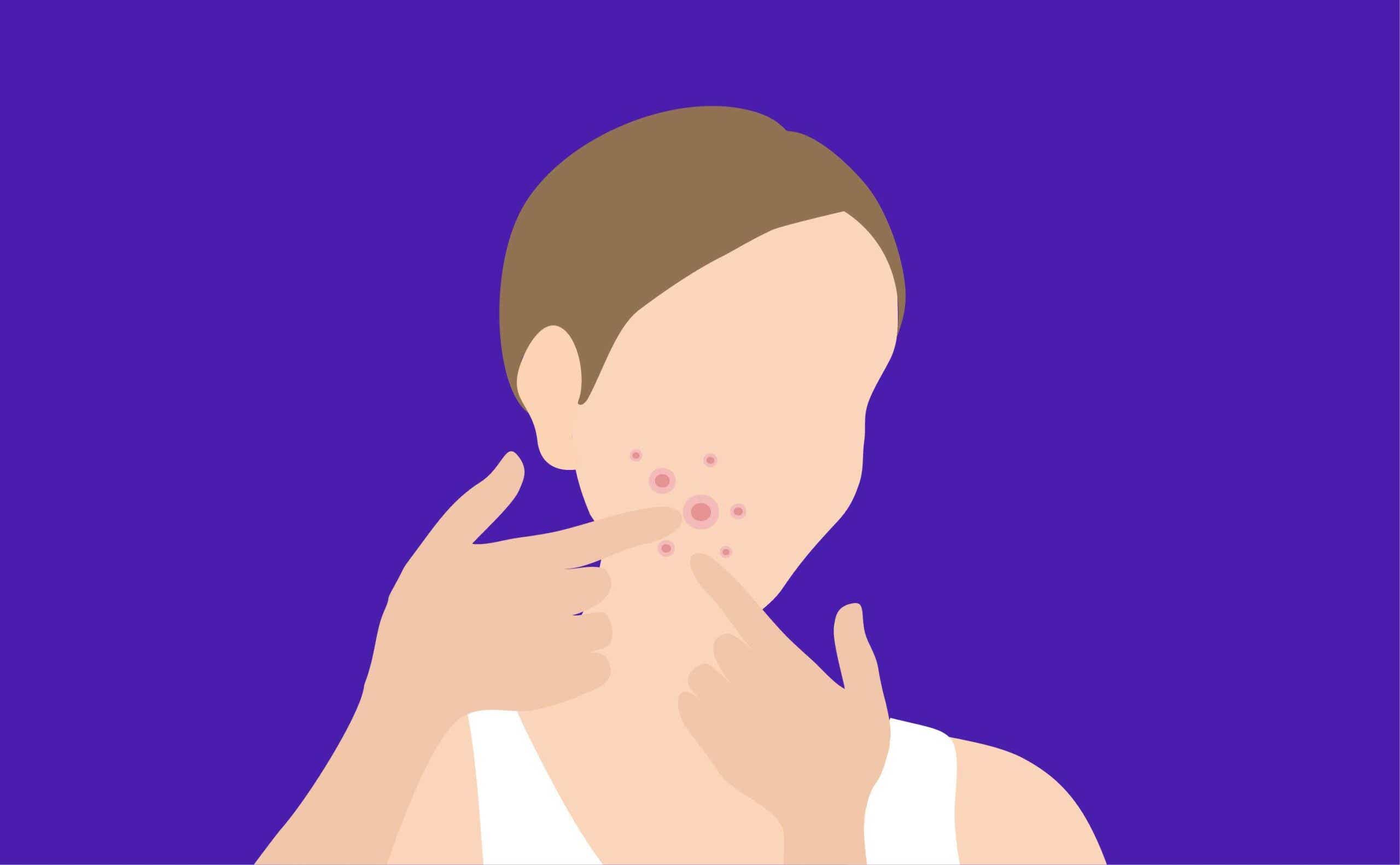 illustration of a woman touching pimples on her chin