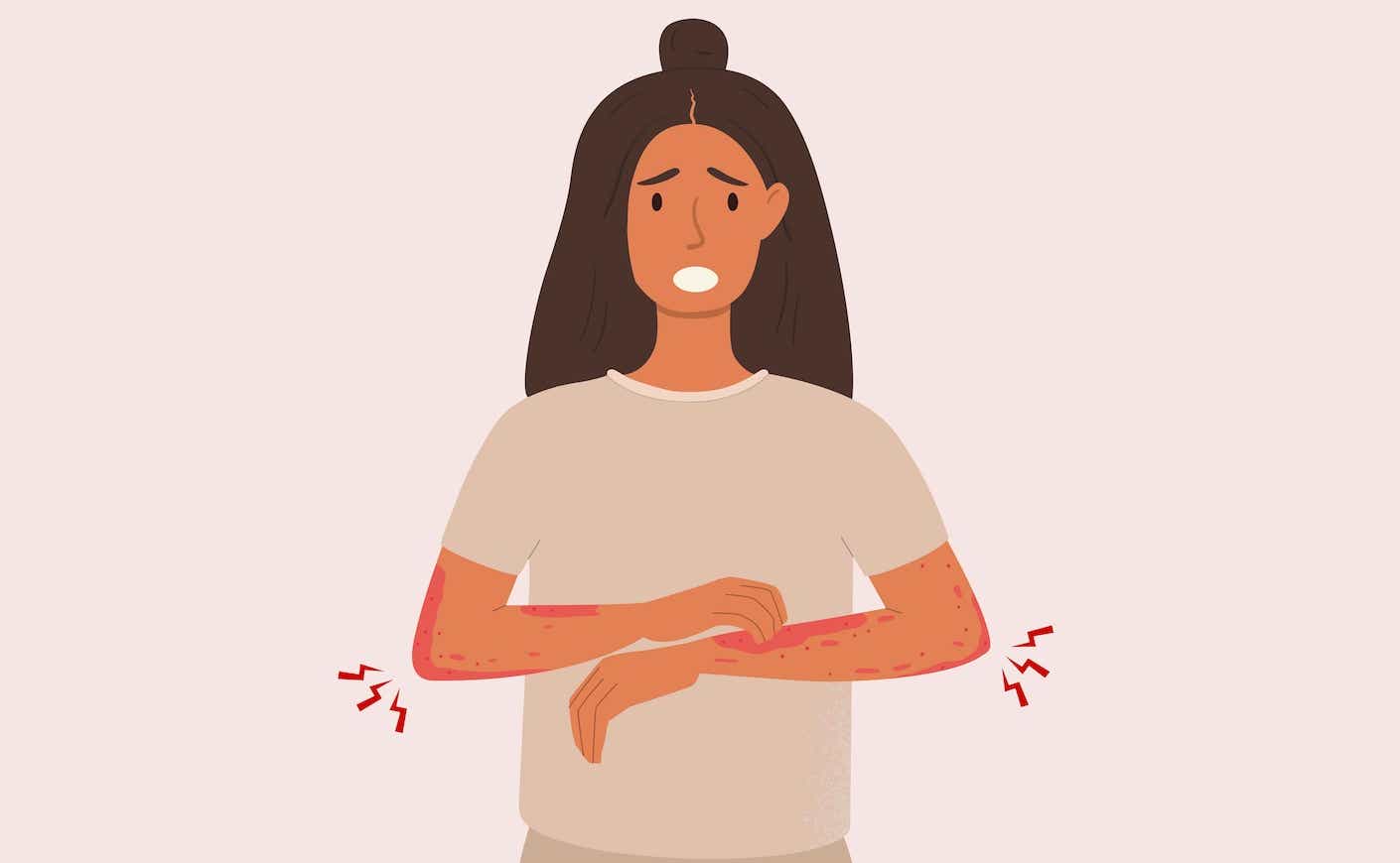 illustration of a woman itching her eczema on her arms