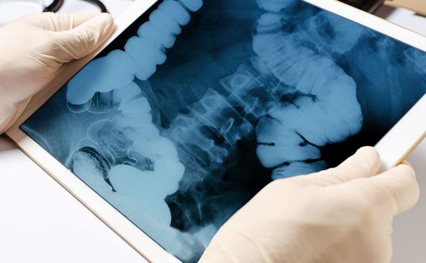 Latex gloved hands holding up a scan of the intestines
