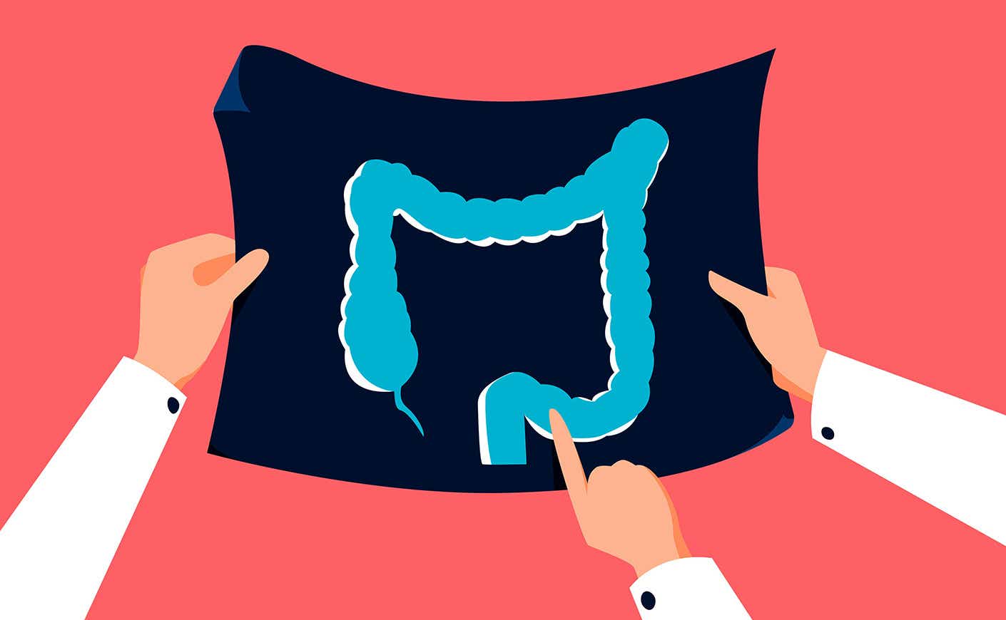 IBS or cancer Digestive Issues That Might Be Colon Cancer