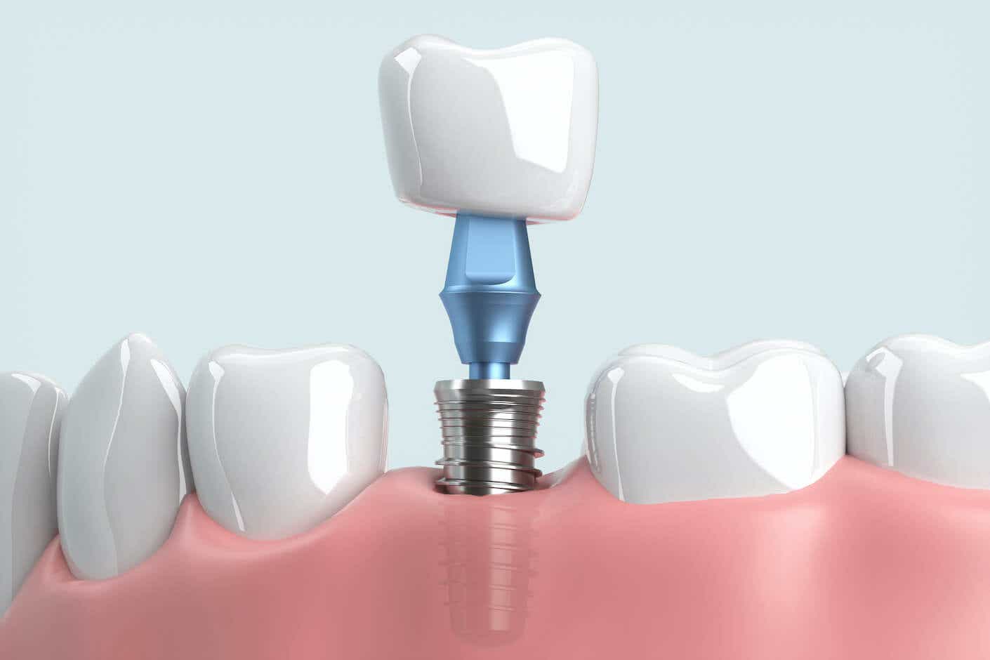 A dental implant being installed