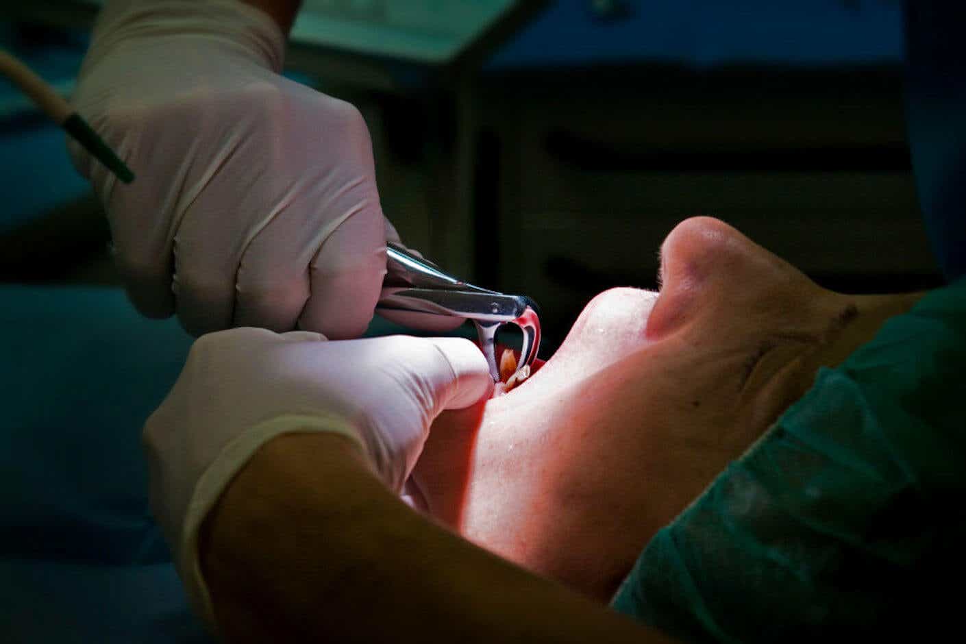 a person's tooth is extracted