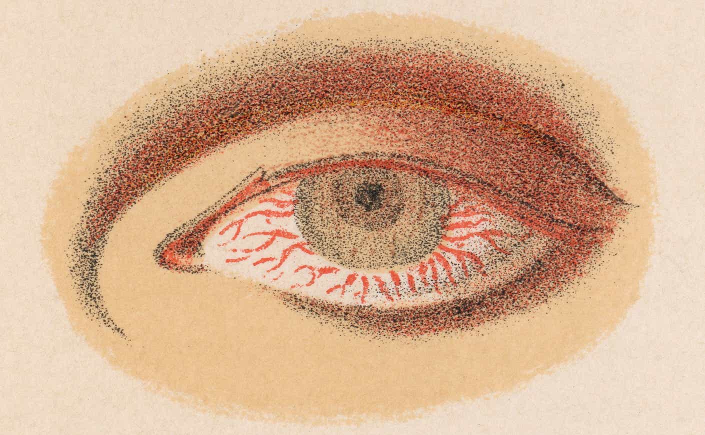 illustration of a bloodshot eye