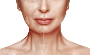 before and after woman with a facelift