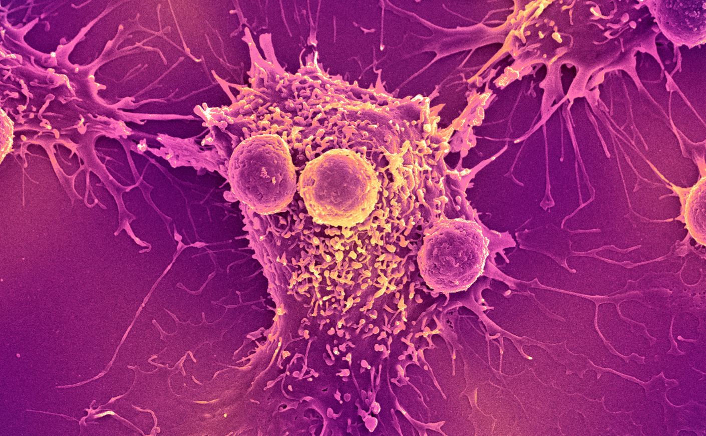 Colored scanning electron micrograph of white blood cells attached to a cancer cell.