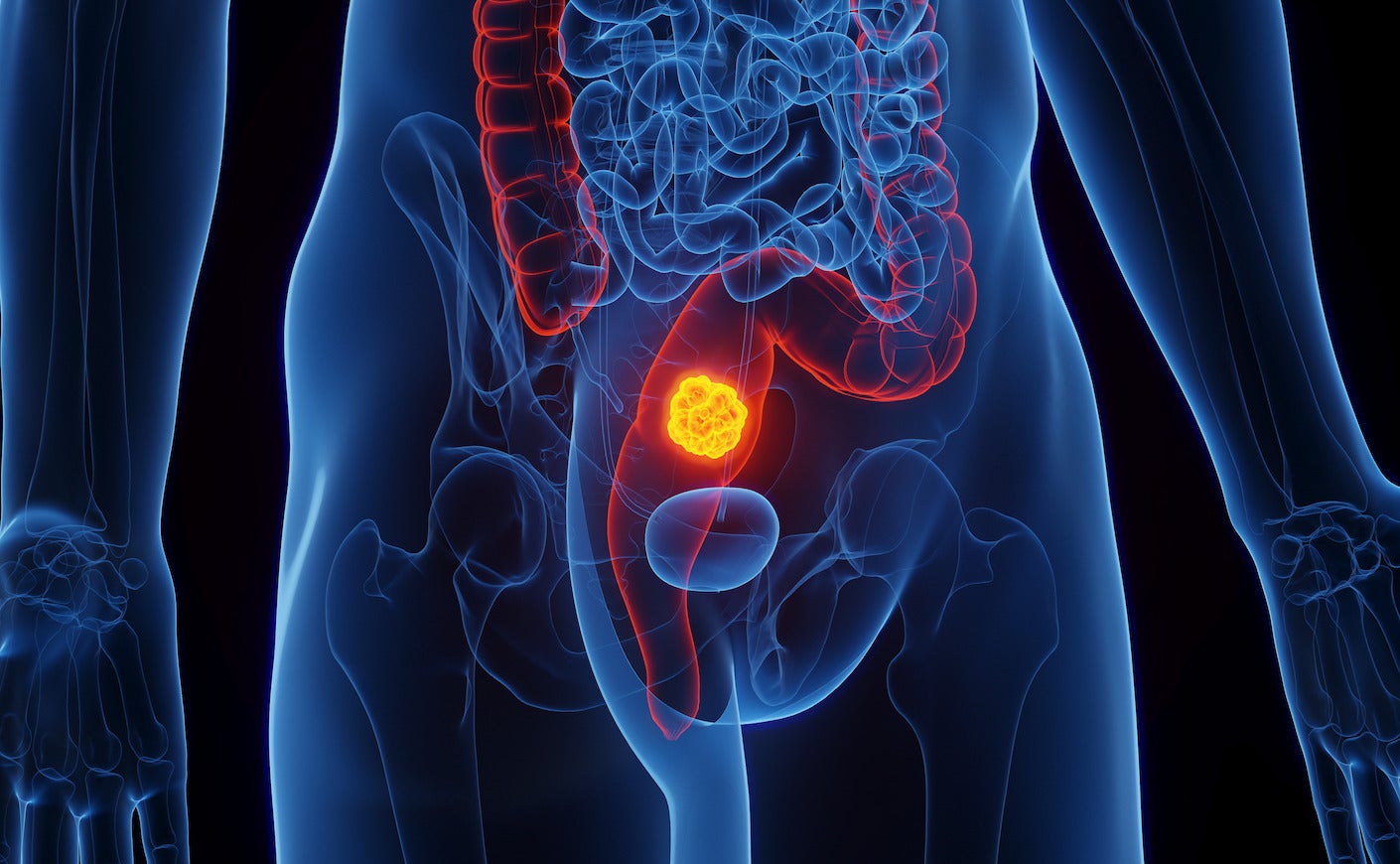 Colon vs. Rectal Cancer: Symptoms, Treatment, Survival Rate