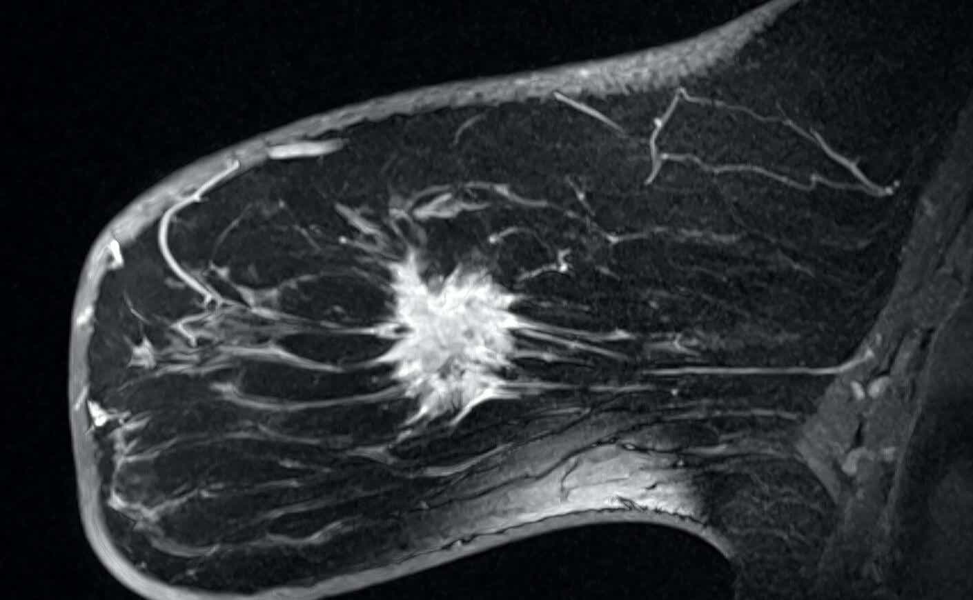 A gadolinium contrast medium has been injected into a breast to show the presence of a malignant tumor. 