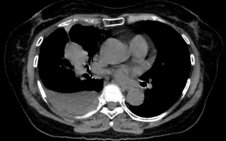 A CT scan showing lung cancer.