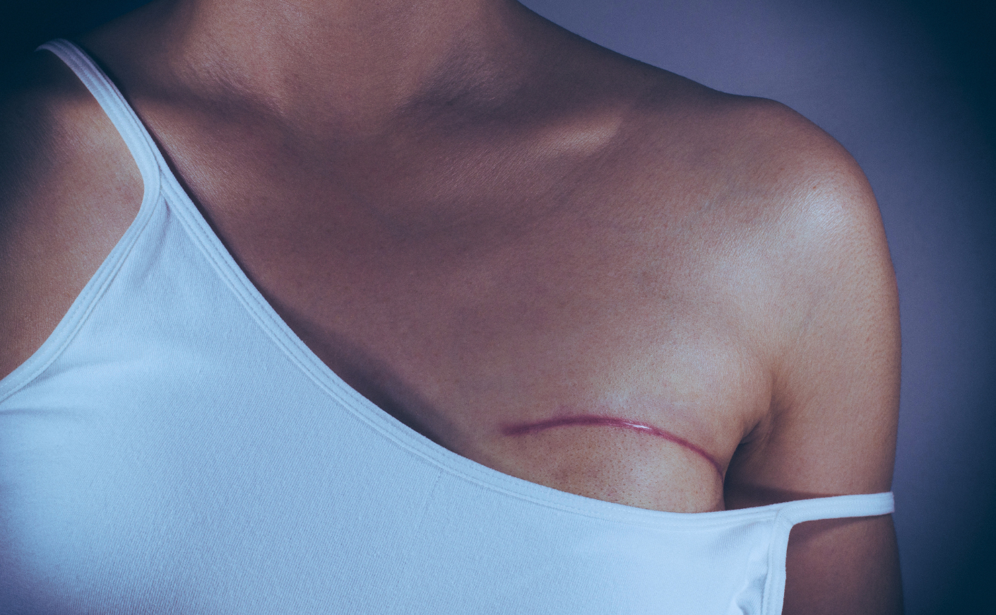 closeup on a womans chest wearing a tanktop with one strap falling down and a scar on her breast showing
