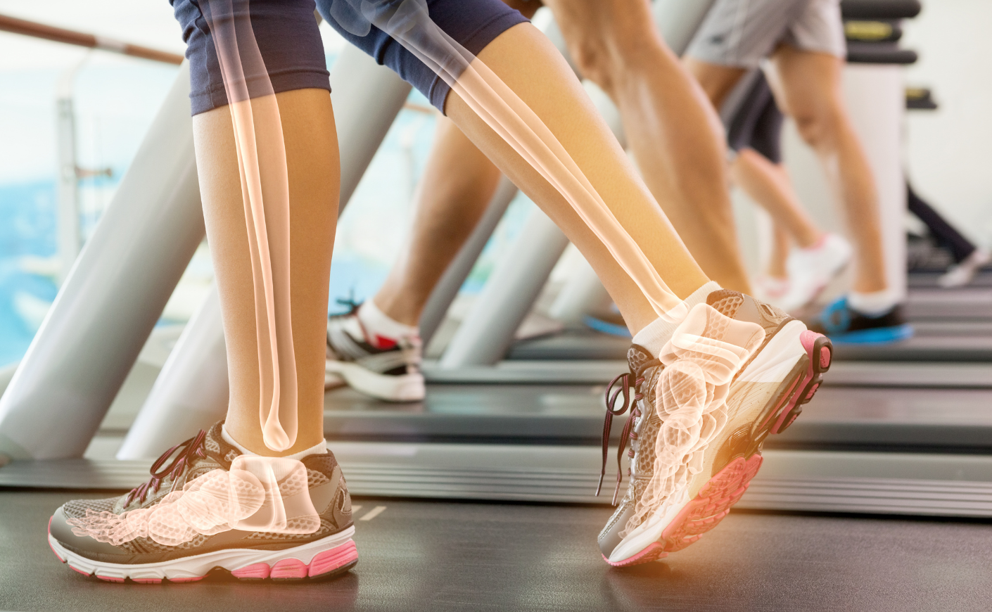 person walking on treadmill with 3d overlay of bones