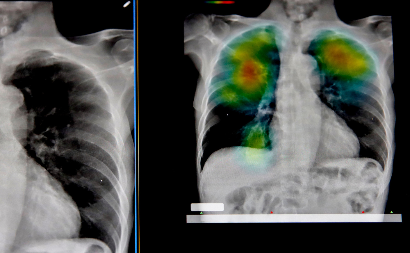 Artificial Intelligence Analysis of Chest X-ray with Heatmap Visualization for Lung Disease Detection